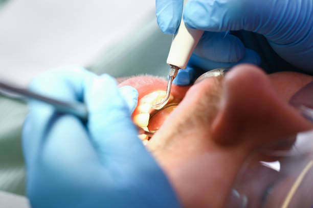 Best Emergency Tooth Extraction in Inverness, FL
